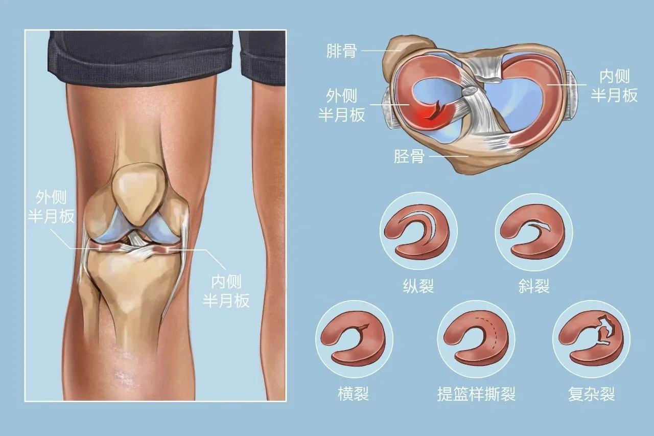 半月板损伤的恢复时间与多种因素相关，几个月能好？