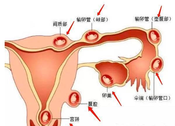 宫外孕三个月的影响与后果